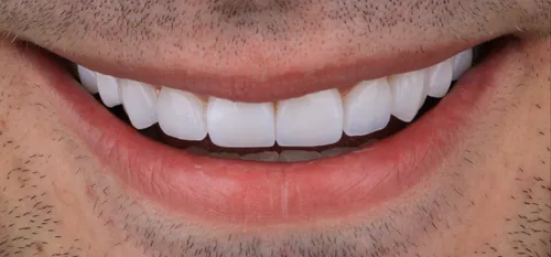 Depois - Diastema